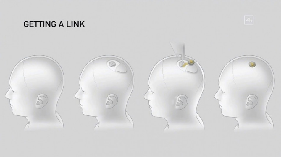 Le premier patient humain de Neuralink contr&ocirc;le une souris d'ordinateur par la pens&eacute;e, affirme Elon Musk